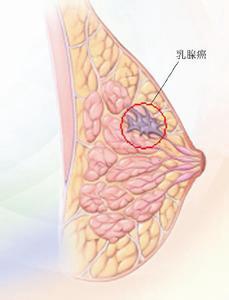 纤维瘤要敷秘方_颈部瘤样纤维炎性病变_泥娃娃敷完了以后要敷面膜吗