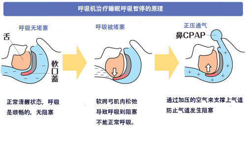 花椒治呼噜_治打呼噜的偏方_哪有快速治呼噜的药物