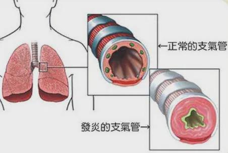 小孩气管炎的偏方_根治气管炎的偏方_治疗气管炎偏方