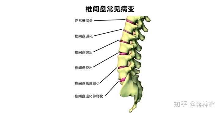 腰间盘突出小偏方_腰间雄盘突出怎么治疗_腰间突出怎么办