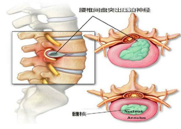 腰间盘突出治疗秘方_腰间椎盘突出注意事项_野杨梅树根可以治腰间突出吗