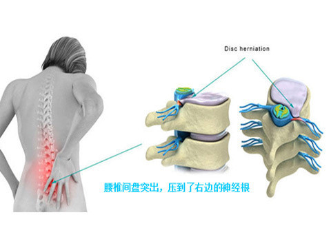 野杨梅树根可以治腰间突出吗_腰间盘突出治疗秘方_腰间椎盘突出注意事项