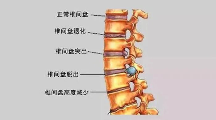 腰椎间盘突出断根秘方_怎么治疗腰椎肩盘突出_杭州腰椎肩盘突出