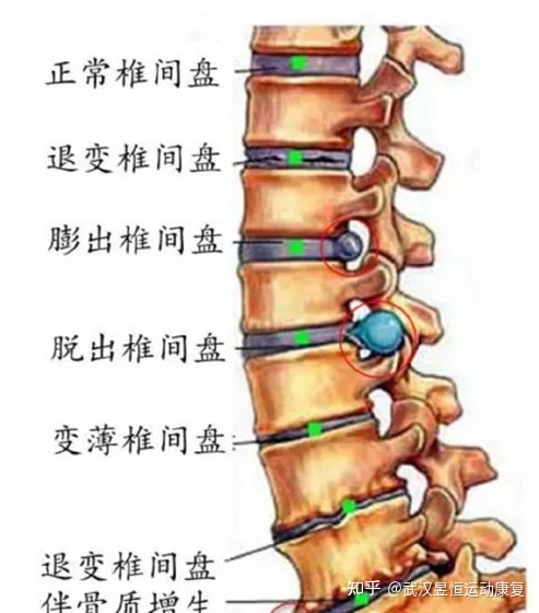 腰椎间盘突出断根秘方_怎么治疗腰椎肩盘突出_杭州腰椎肩盘突出