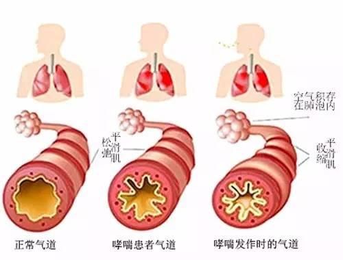 肺里有痰怎么清除偏方_肺气肿偏方_排肺毒最快的偏方