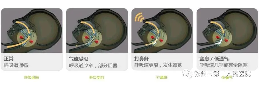 桑螵蛸偏方治咽炎的偏方_治打呼噜偏方_鸡呼噜病偏方