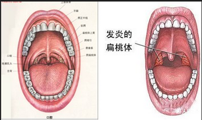 扁桃体发炎偏方大全效果好的