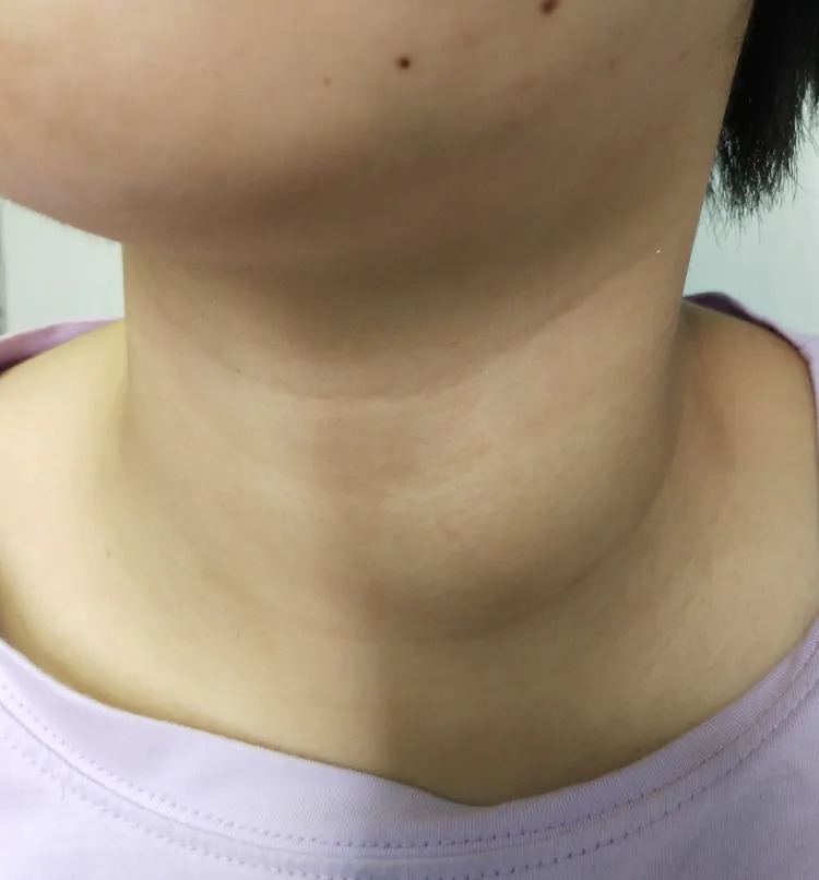 甲状腺初期图片图片