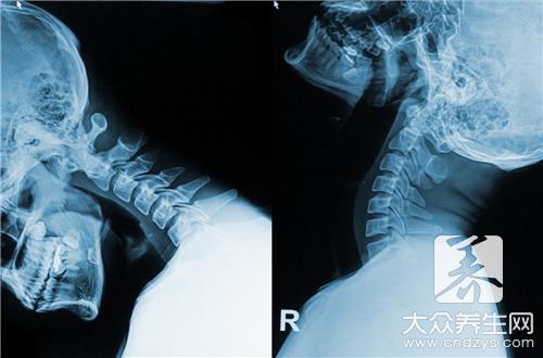 颈椎病治疗偏方  