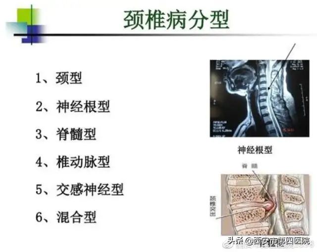 颈椎骨质增生偏方大全_颈椎病偏方_民间治疗颈椎病的偏方