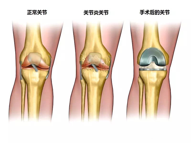 支气管炎和支原体炎治疗偏方_治疗类风湿关节炎的偏方_治疗关节炎偏方