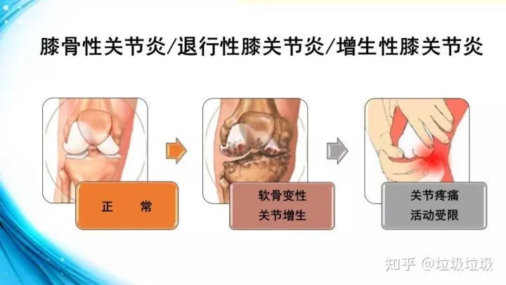 治疗类风湿关节炎的偏方_支气管炎和支原体炎治疗偏方_治疗关节炎偏方