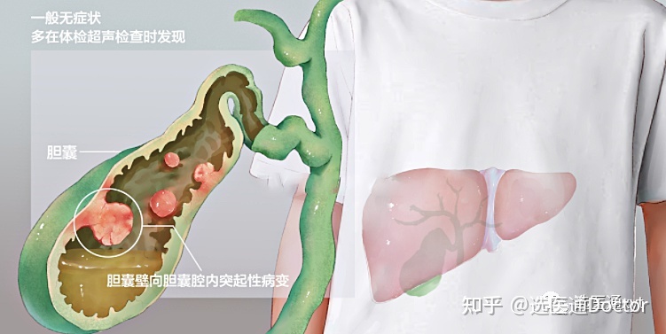 胆囊有息肉要紧吗_胆囊息肉偏方_胆囊既有息肉又有结石