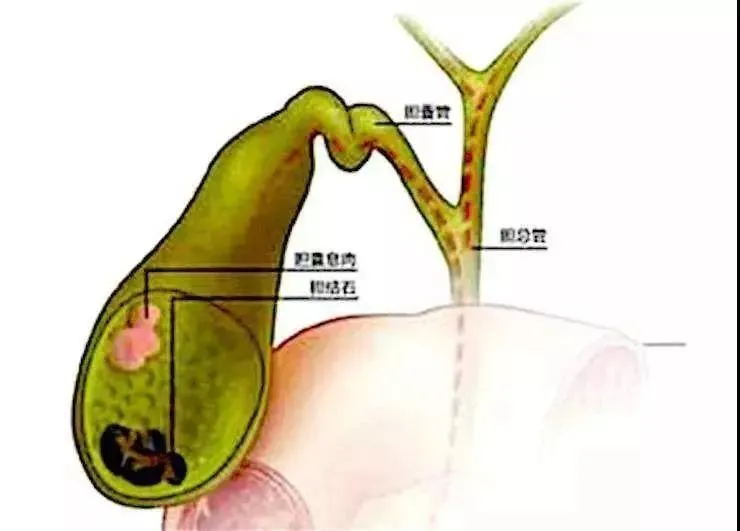 胆囊息肉偏方_胆囊既有息肉又有结石_胆囊有息肉要紧吗