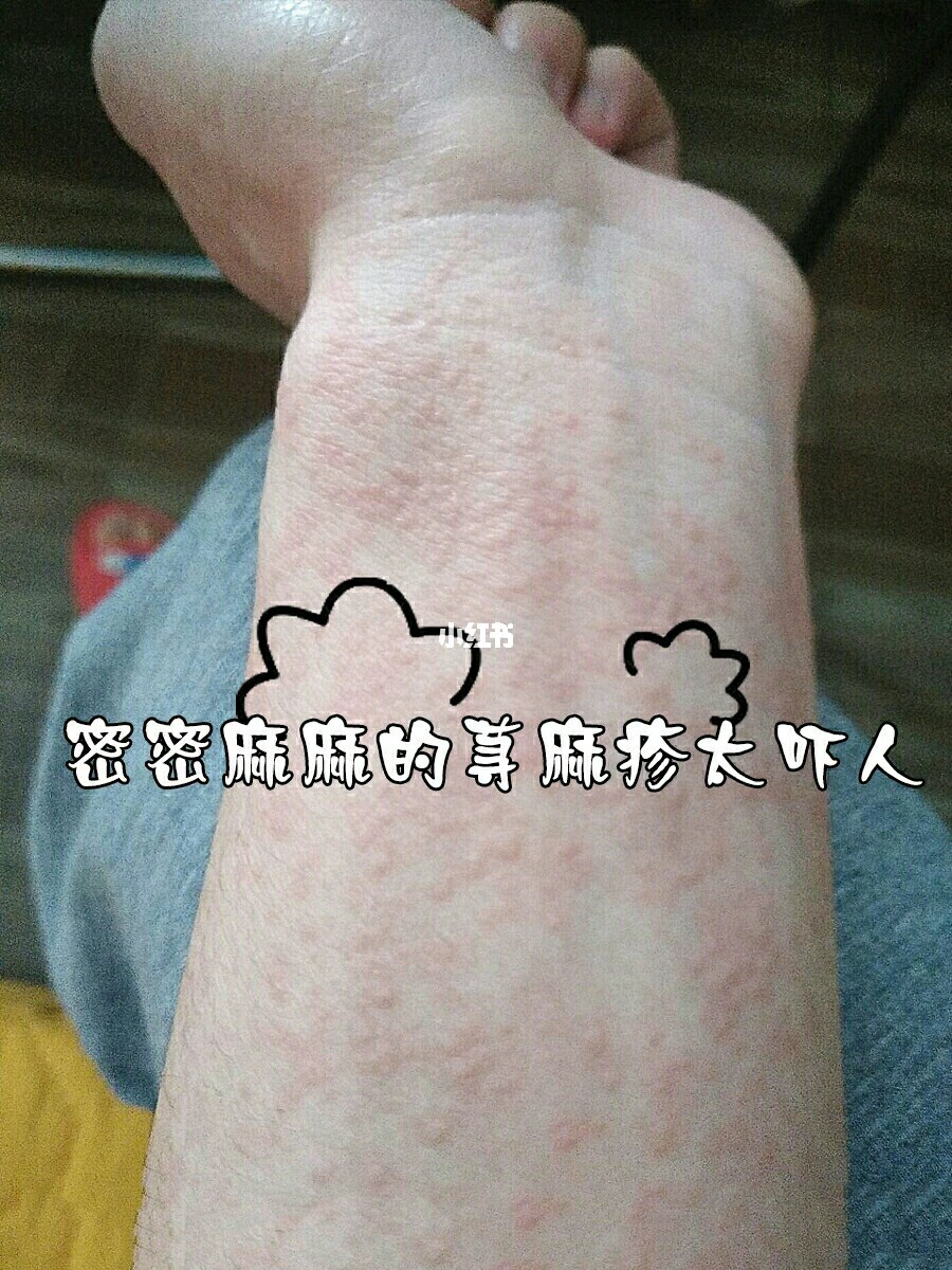 荨荨善诱txt耳东兔子_寒冷性荨麻疹偏方_丘荨性荨麻疹怎么办