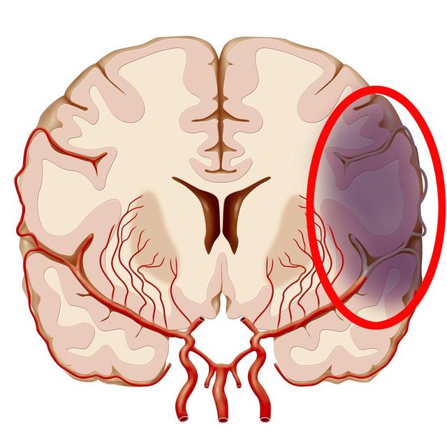 脑梗塞偏方_苹果醋姜汁偏方治脑梗_脑腔隙性梗塞怎么治