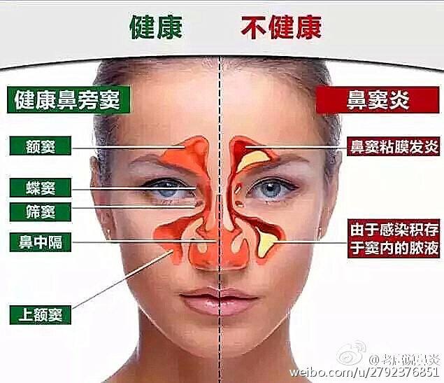 鼻窦炎的最好治疗偏方_治疗鼻窦炎的妙招小偏方_老年阴炎中医治疗偏方