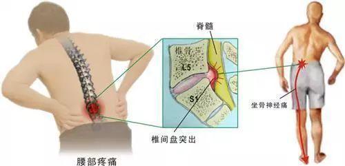 腰椎间盘突出断根秘方_腰椎尖盘突出症的治疗_如何治疗腰椎肩盘突出