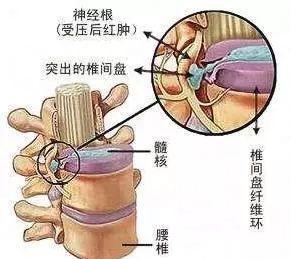 如何治疗腰椎肩盘突出_腰椎尖盘突出症的治疗_腰椎间盘突出断根秘方