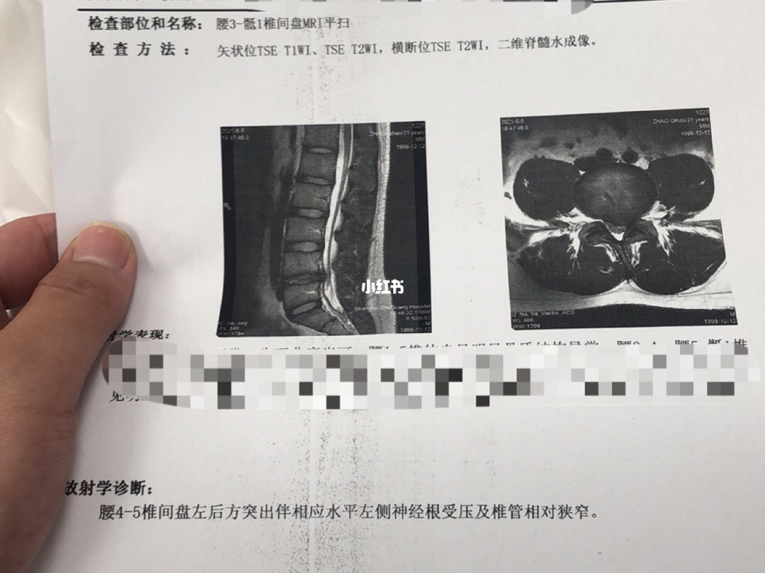 腰椎间盘突出断根秘方_腰椎节盘突出治疗方法_腰椎肩盘突出会出现腰骶骨疼吗?