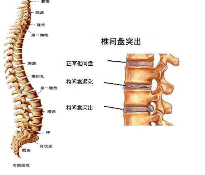 腰椎间盘突出断根秘方_腰椎节盘突出治疗方法_腰椎肩盘突出会出现腰骶骨疼吗?