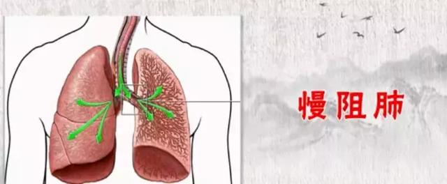 肺纤维,增殖灶_肺纤维化的偏方治疗_肺纤维化的偏方治疗