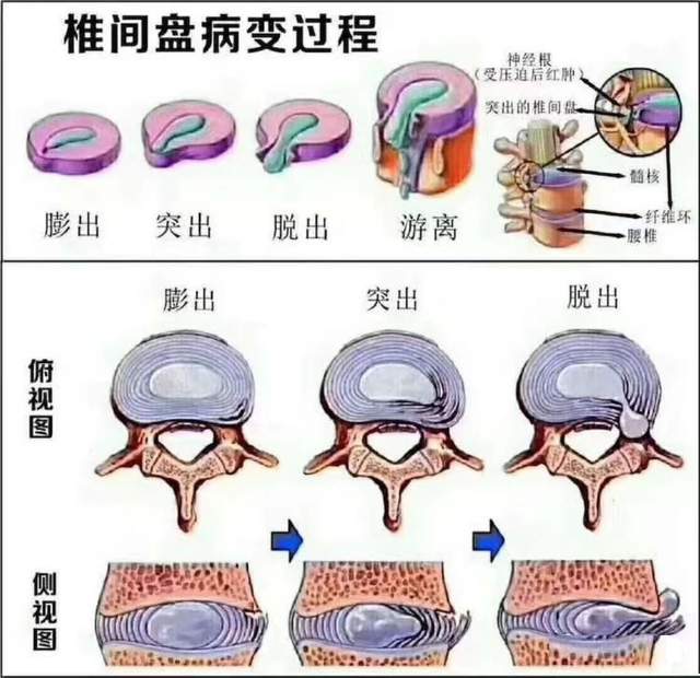 腰椎突出症的西药治疗_腰椎间盘突出症的治疗偏方_腰椎问盘突出怎么治疗