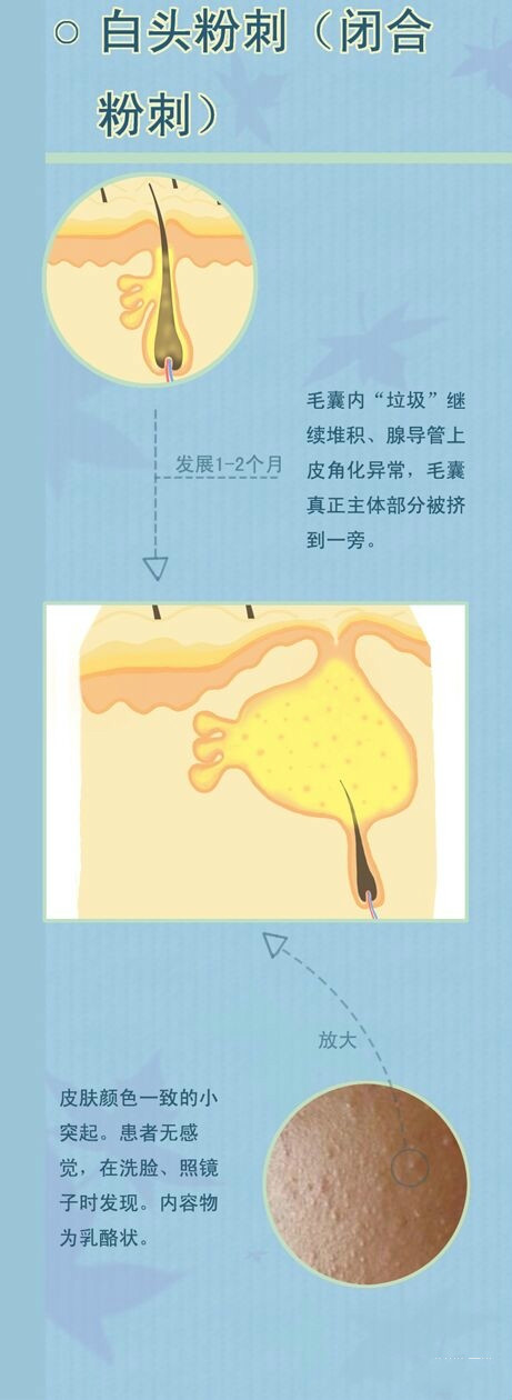 痤疮中医还是西医治疗_痤疮中医治疗医院好_中医治疗痤疮