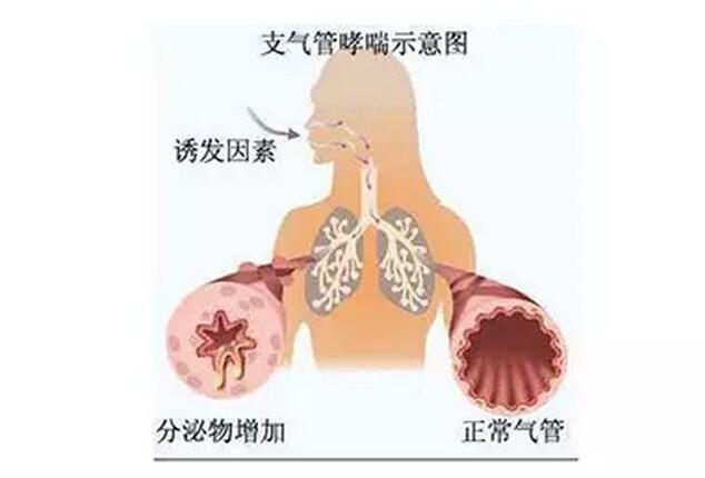 咳嗽性哮喘有什么偏方_治疗过敏哮喘的偏方_过敏性哮喘的偏方