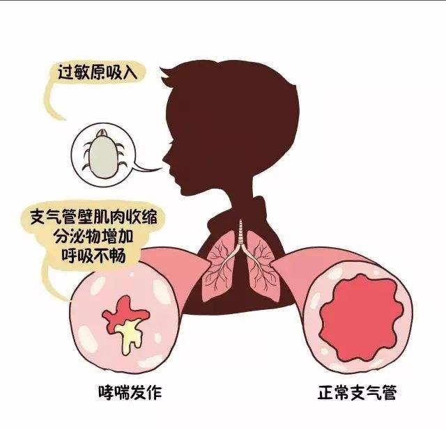 过敏性哮喘的偏方_治疗过敏哮喘的偏方_咳嗽性哮喘有什么偏方