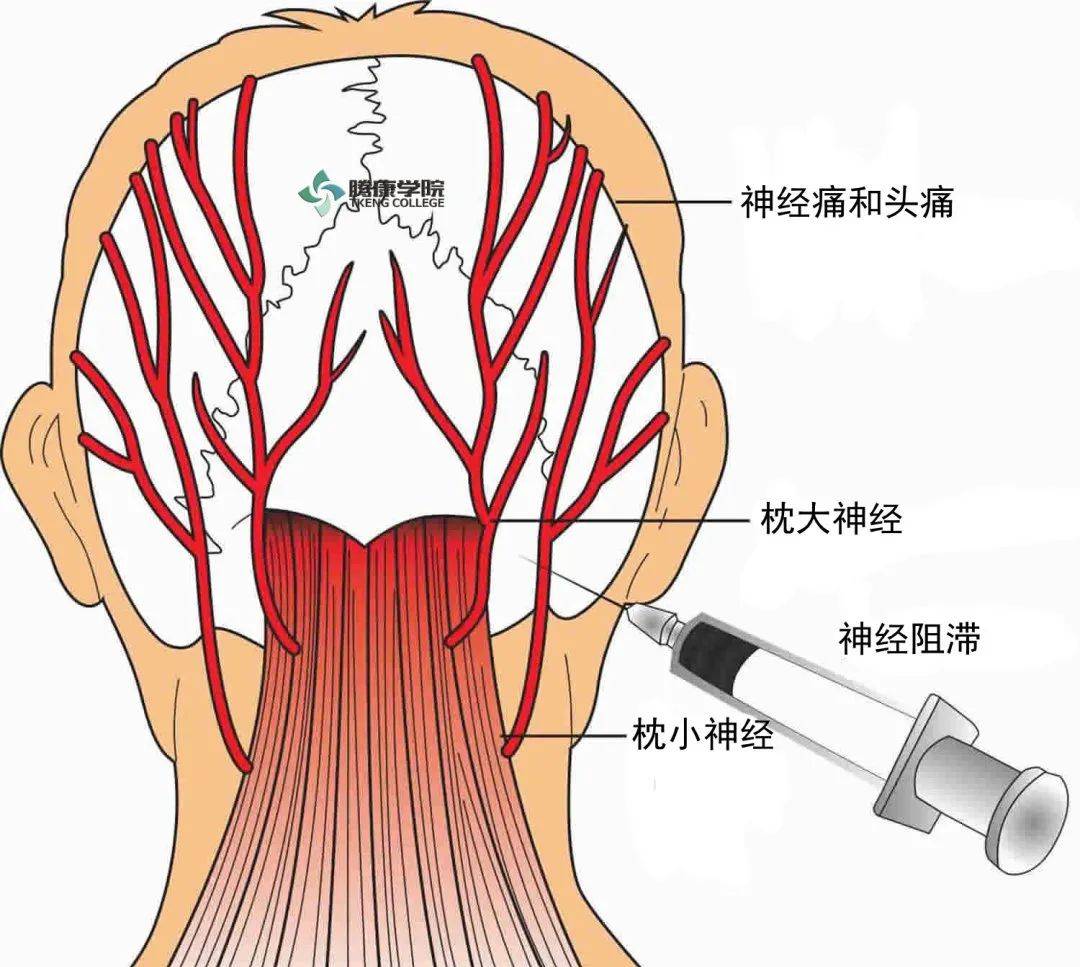 颈椎压迫神经头痛偏方_老年人头痛偏方_偏头痛有没有什么偏方