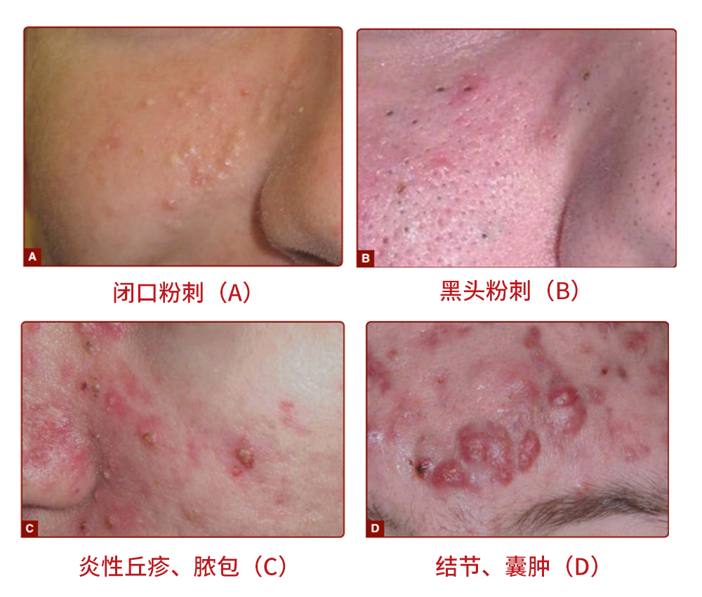 祖传救命老偏方_治疗粉刺痤疮的偏方_祖传治疗痤疮的老偏方