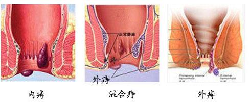 长期便秘，得痔疮！？一个食疗秘方，通大便、防痔疮