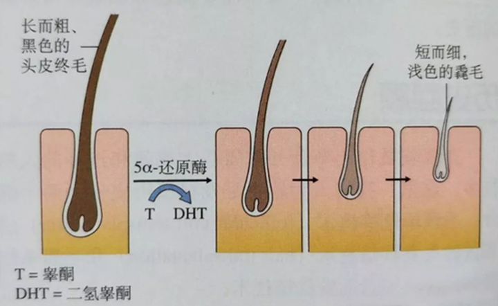 脂溢性脱发偏方_脂溢脱发原因及治疗_脂溢脱发原因