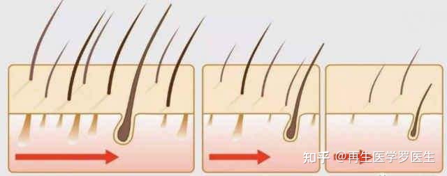 脂溢脱发原因_脂溢性脱发偏方_脂溢脱发原因及治疗