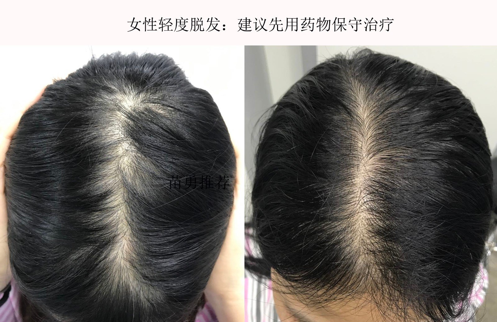 女性脱发偏方_雄性脱发的治疗偏方_女性脱发偏方