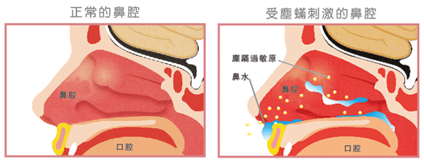 治疗鼻窦炎的妙招小偏方