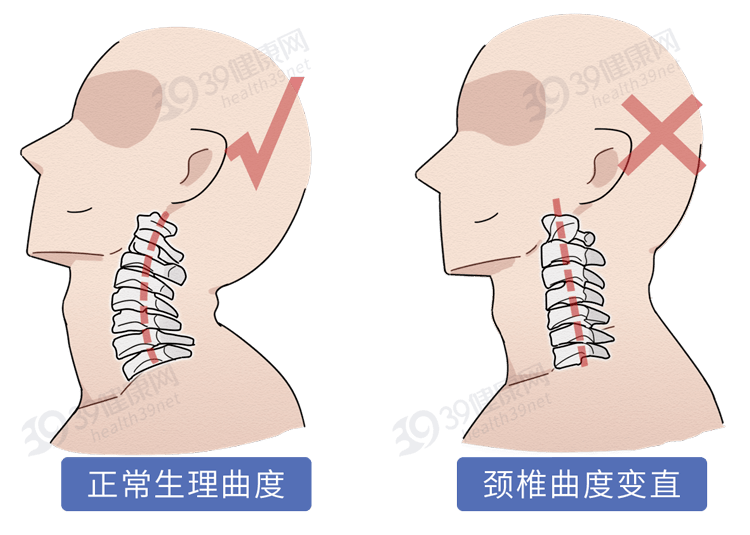 颈椎病治疗偏方