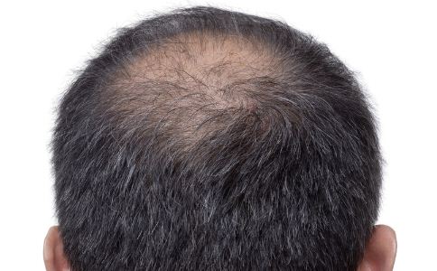 肾虚脱发 脂溢 区别_脂溢脱发原因及治疗_脂溢性脱发偏方