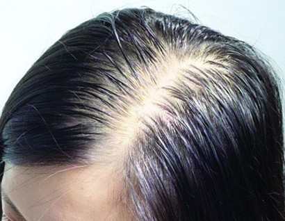 脂溢脱发原因及治疗_肾虚脱发 脂溢 区别_脂溢性脱发偏方