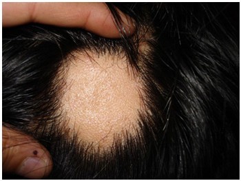 脂溢性脱发偏方_脂溢脱发原因及治疗_肾虚脱发 脂溢 区别