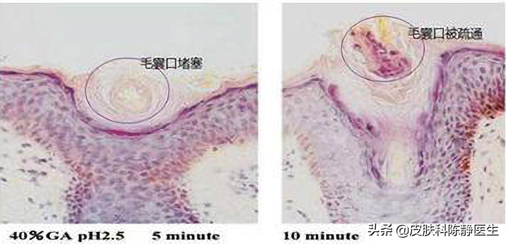 治疗脸上的痘痘怎么治疗_治疗痘痘偏方_中医偏方治疗脖子上痘痘