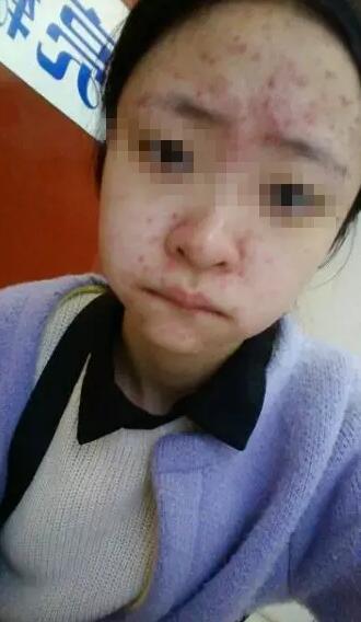 蜂蜜加“它”坚持半月解决3年痘痘，做自信无痘少女