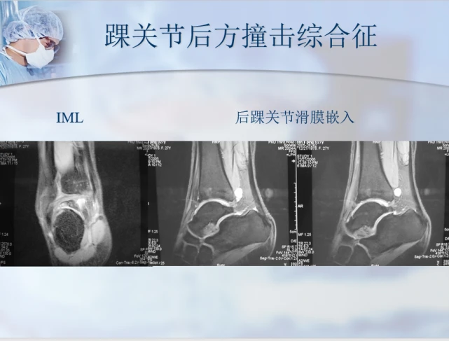 治疗骨刺的偏方