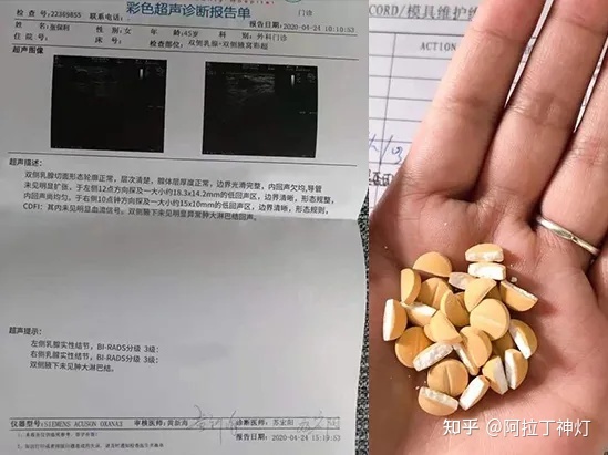 乳腺结节吃什么散结快偏方_根治乳腺结节偏方_双侧乳腺小叶增生 右侧乳腺结节