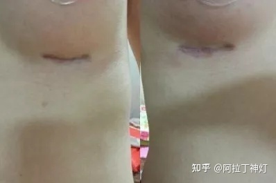 双侧乳腺小叶增生 右侧乳腺结节_根治乳腺结节偏方_乳腺结节吃什么散结快偏方