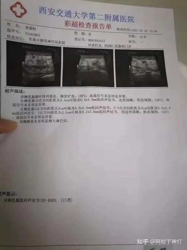 根治乳腺结节偏方_双侧乳腺小叶增生 右侧乳腺结节_乳腺结节吃什么散结快偏方