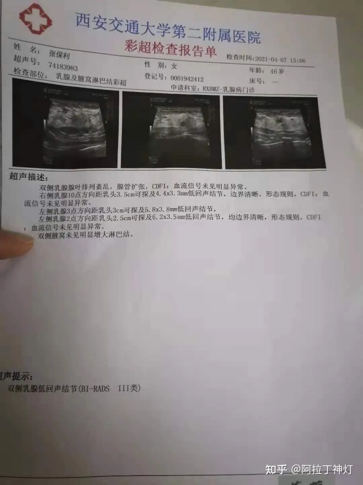 双侧乳腺小叶增生 右侧乳腺结节_乳腺结节吃什么散结快偏方_根治乳腺结节偏方