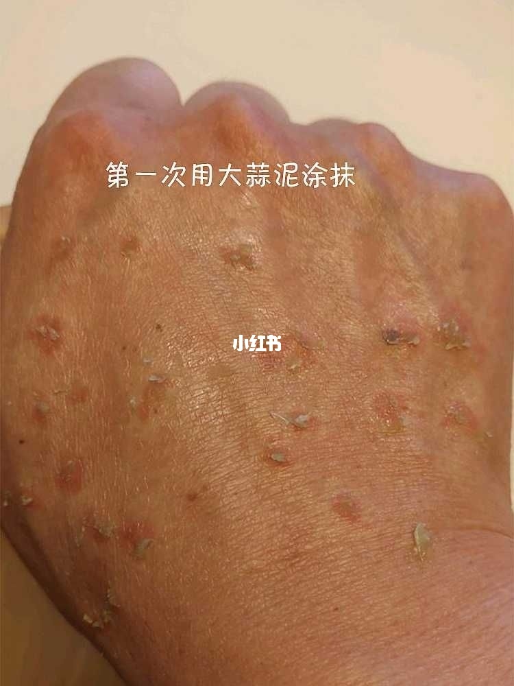 扁平疣用大蒜偏方