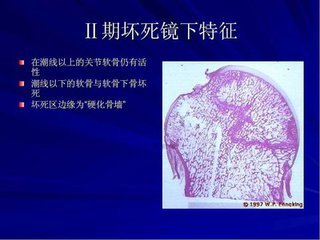 骨头坏死 治疗_胡骨头坏死怎么治疗_治疗股骨头坏死秘方